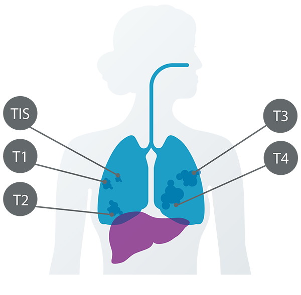 Genentech: Decoding A Breast Cancer Diagnosis